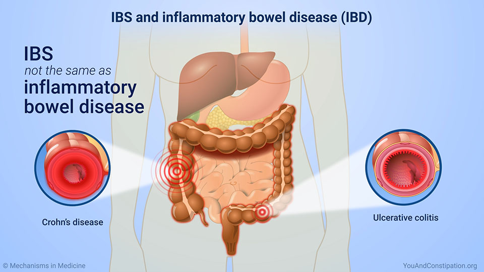 IBS and inflammatory bowel disease (IBD)