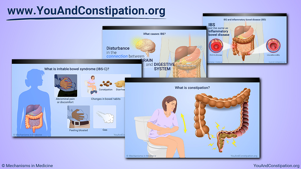 Slide Show - Understanding IBS-C