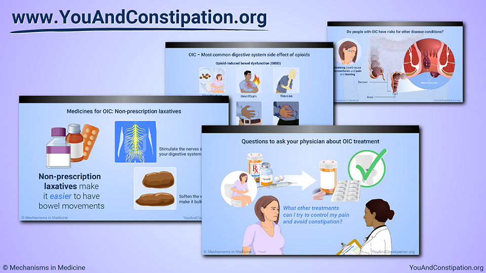 Managing and Treating Opioid-Induced Constipation