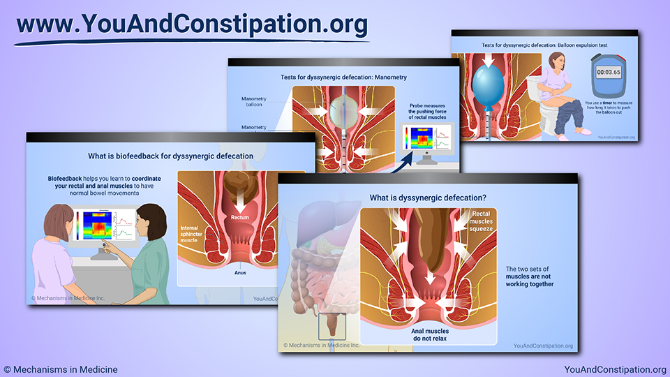 Slide Show - Understanding Dyssynergic Defecation
