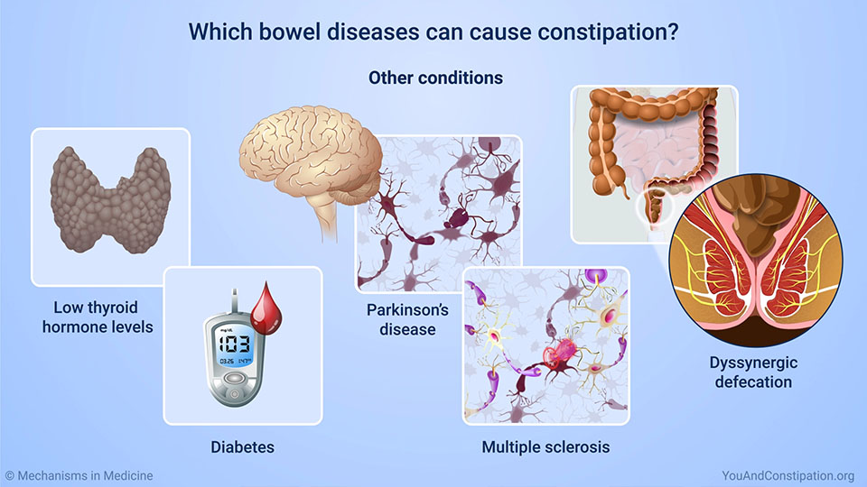Which bowel diseases can cause constipation?