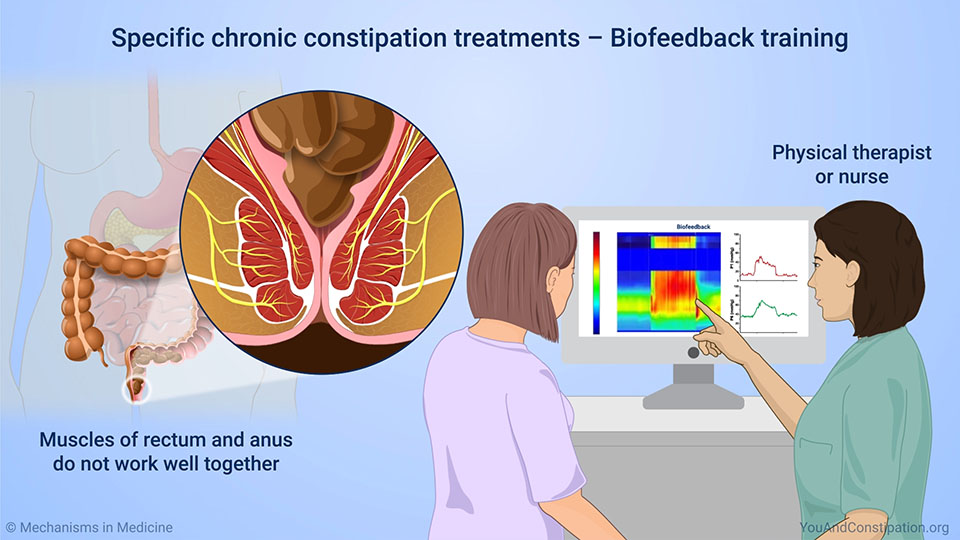 Specific chronic constipation treatments – Biofeedback training