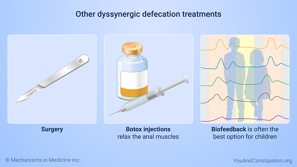 Other dyssynergic defecation treatments