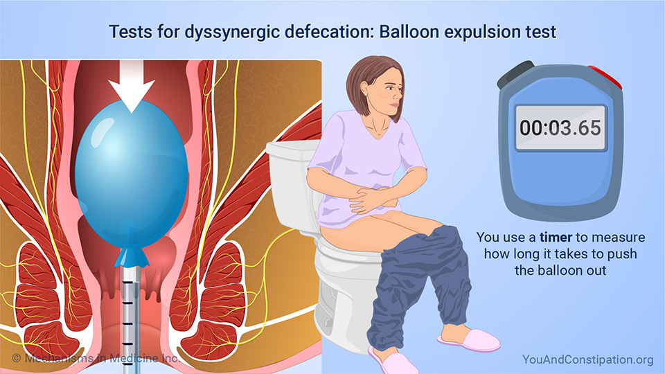 Tests for dyssynergic defecation: Balloon expulsion test