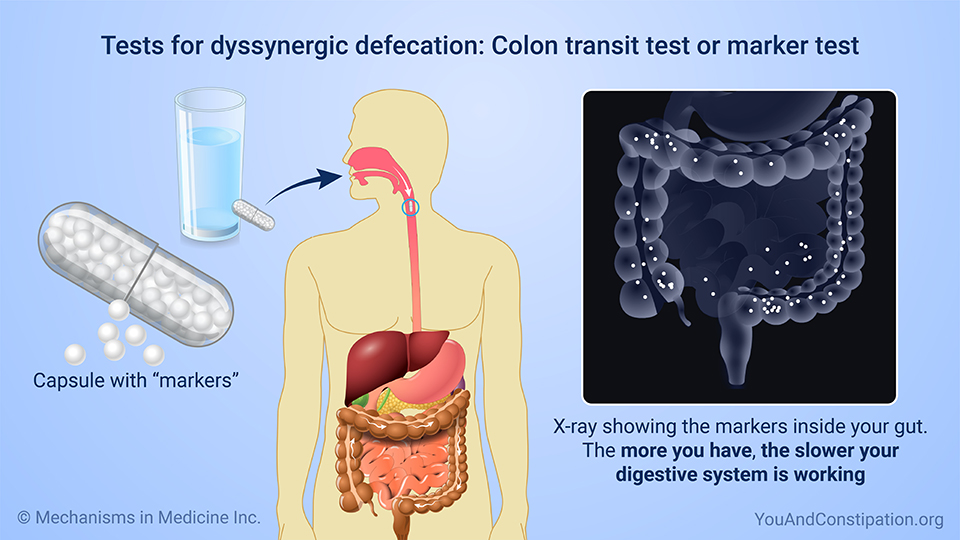 Tests for dyssynergic defecation: Colon transit test or marker test