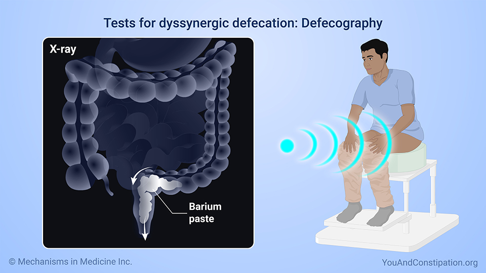 Tests for dyssynergic defecation: Defecography