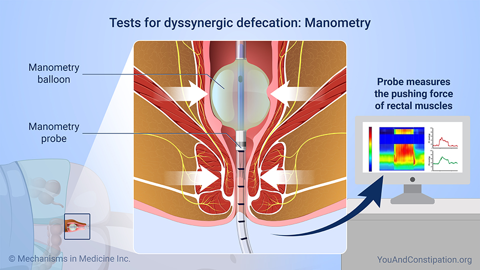 Tests for dyssynergic defecation: Manometry