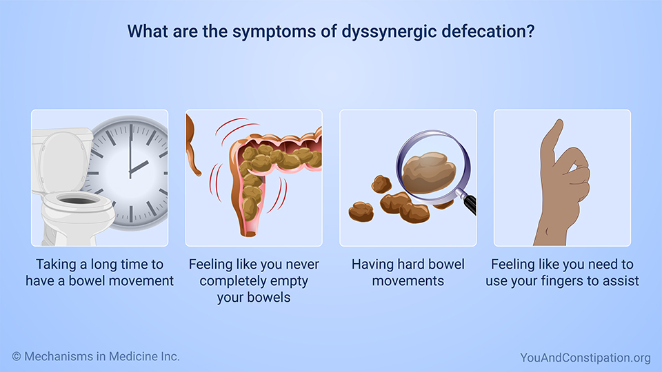 What are the symptoms of dyssynergic defecation?