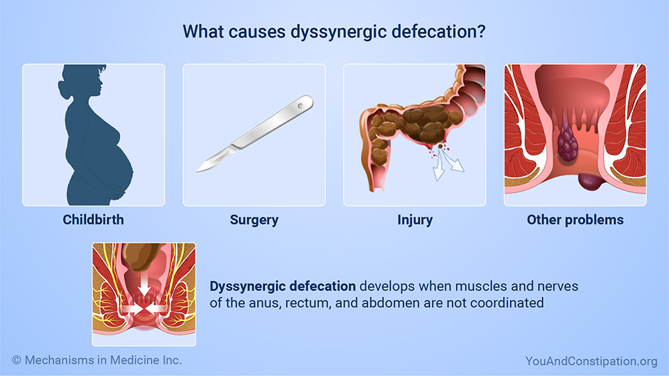 What causes dyssynergic defecation?