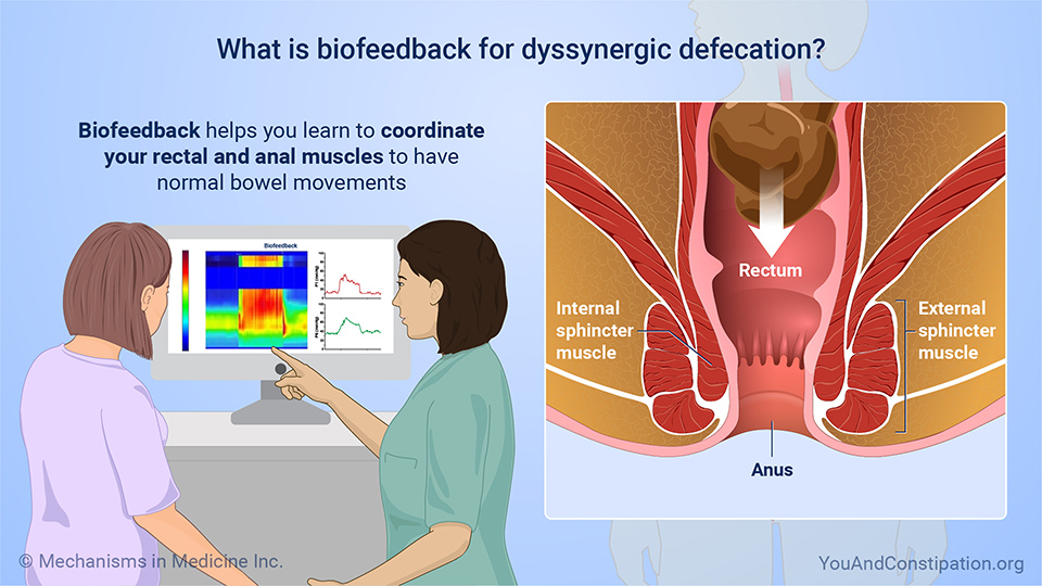 What is biofeedback for dyssynergic defecation?