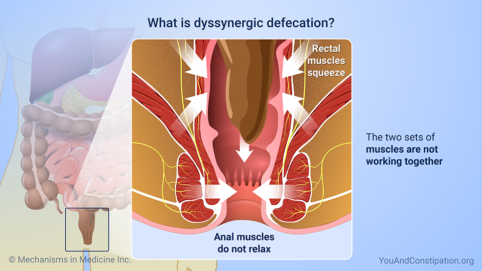 What is dyssynergic defecation?