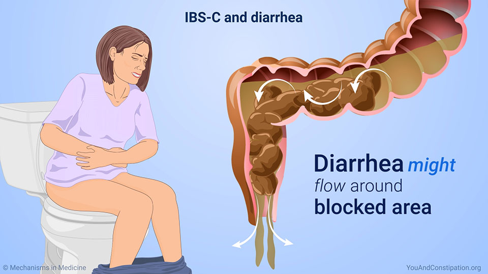 IBS-C and diarrhea