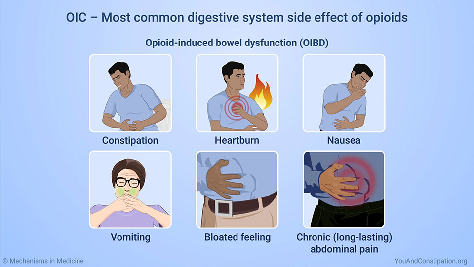 OIC – Most common digestive system side effect of opioids