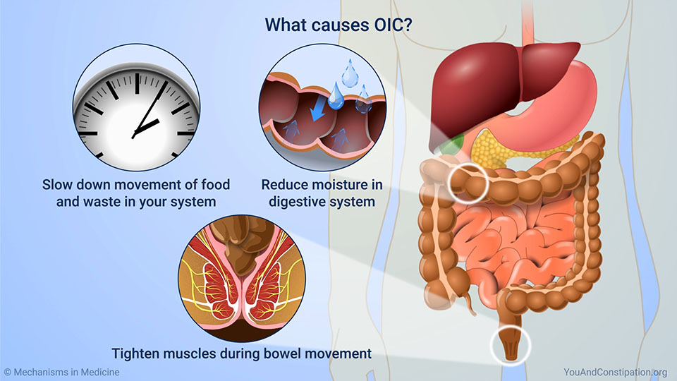 What causes OIC?